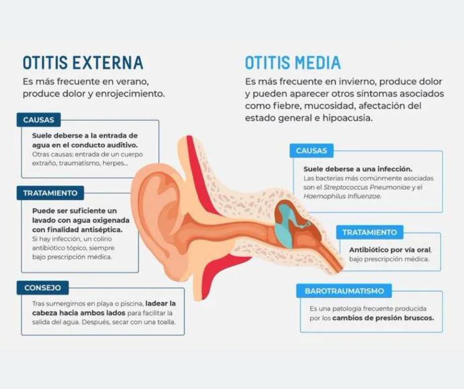 Otitis externa e interna - infografía