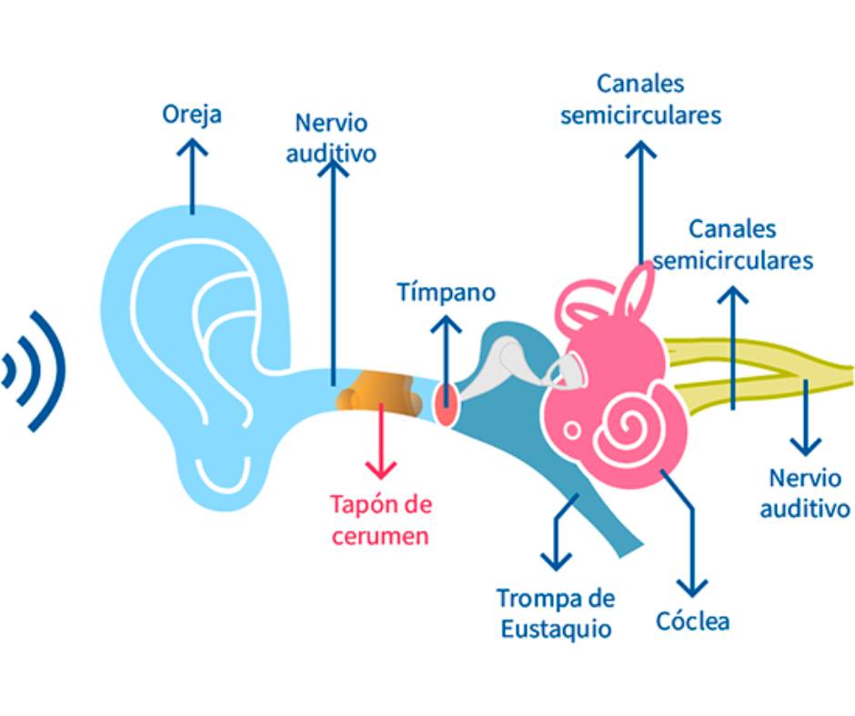 Tapón de cerumen